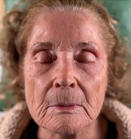 tranformation_botox-fillers-80yrs-05