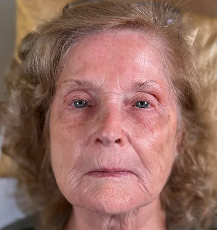 tranformation_botox-fillers-80yrs-06