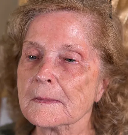 tranformation_botox-fillers-80yrs-08