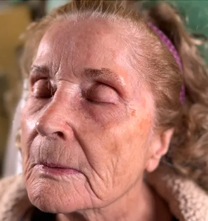 tranformation_botox-fillers-80yrs-09