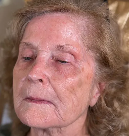 tranformation_botox-fillers-80yrs-10