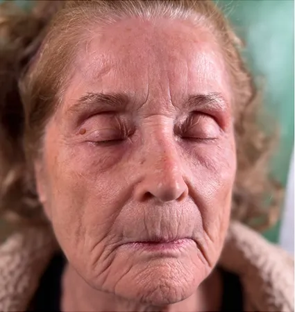 tranformation_botox-fillers-80yrs-11