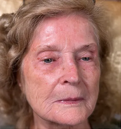 tranformation_botox-fillers-80yrs-12