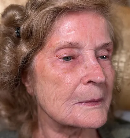tranformation_botox-fillers-80yrs-14