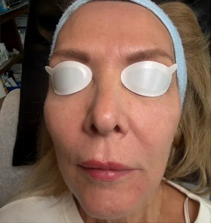 tranformation_lasers-fillers-02