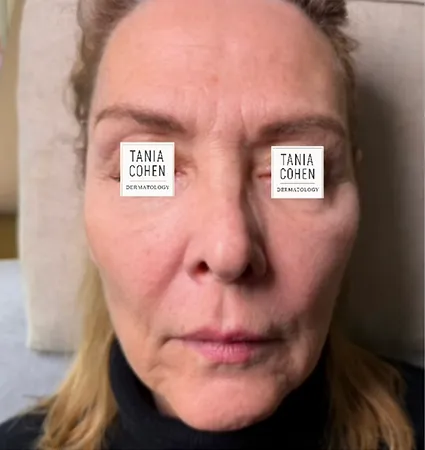 tranformation_lasers-fillers-03