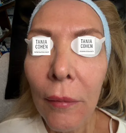 tranformation_lasers-fillers-04