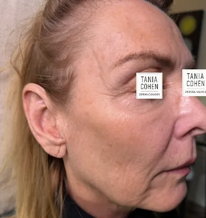 tranformation_lasers-fillers-05