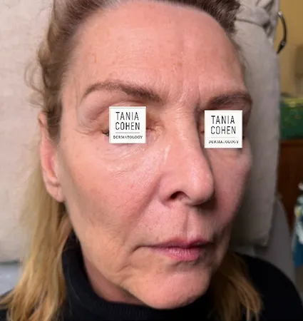 tranformation_lasers-fillers-07