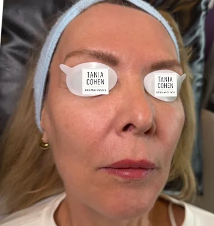 tranformation_lasers-fillers-08