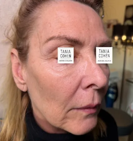 tranformation_lasers-fillers-09