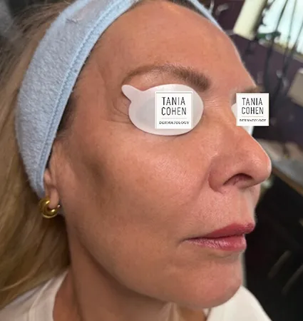 tranformation_lasers-fillers-10