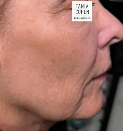 tranformation_lasers-fillers-11