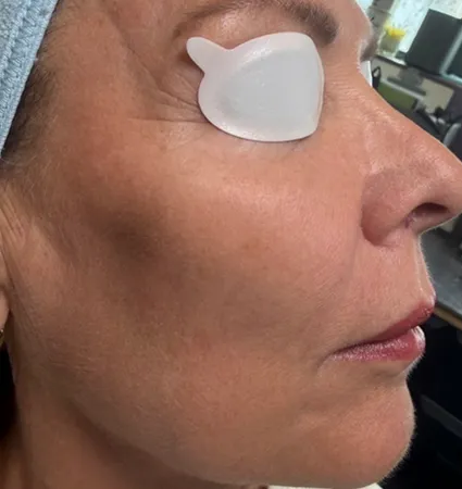 tranformation_lasers-fillers-12