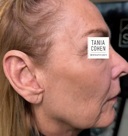 tranformation_lasers-fillers-13