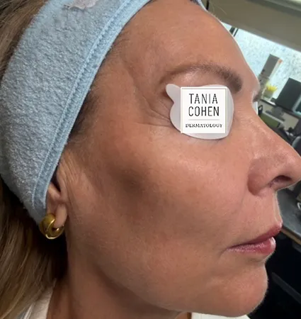tranformation_lasers-fillers-14