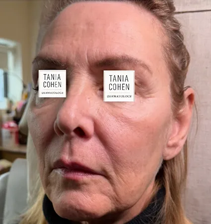 tranformation_lasers-fillers-15