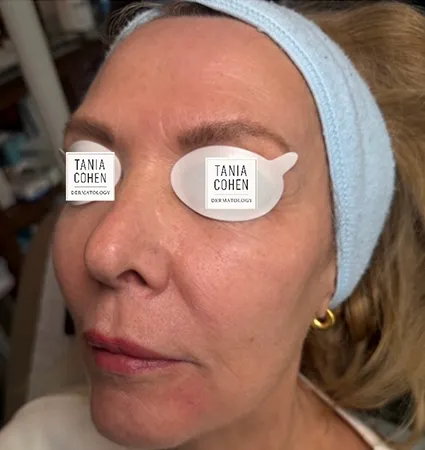 tranformation_lasers-fillers-16