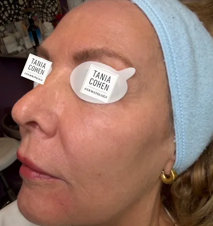 tranformation_lasers-fillers-18