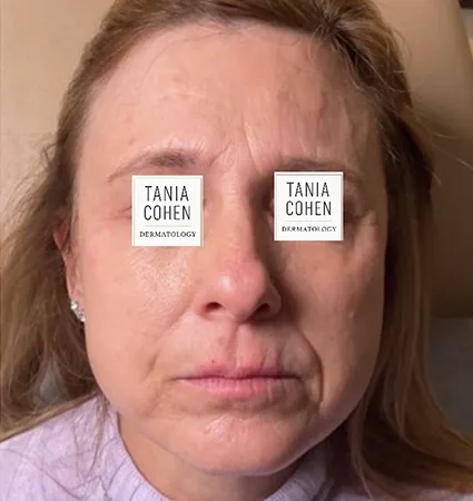 transformations_botox-fillers-pat-2-01