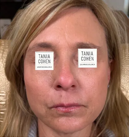 transformations_botox-fillers-pat-2-02