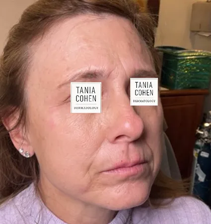 transformations_botox-fillers-pat-2-03