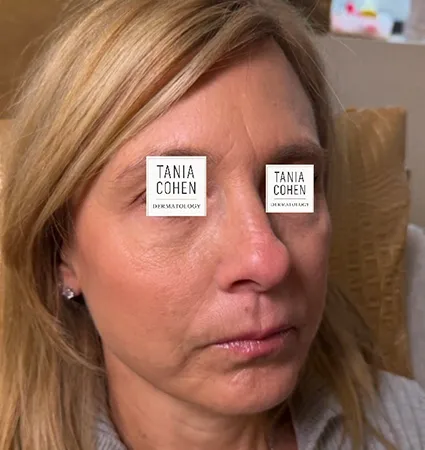 transformations_botox-fillers-pat-2-04