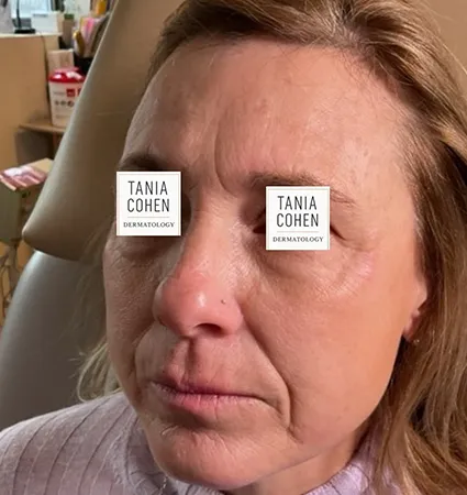 transformations_botox-fillers-pat-2-05