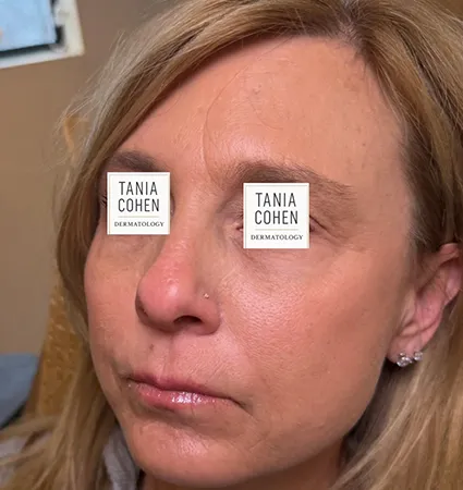 transformations_botox-fillers-pat-2-06