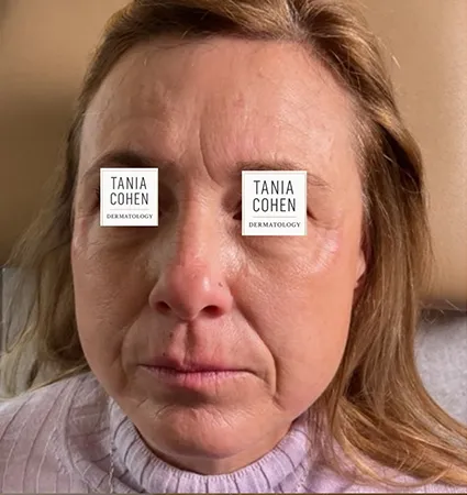 transformations_botox-fillers-pat-2-07