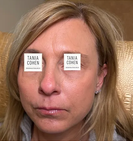 transformations_botox-fillers-pat-2-08