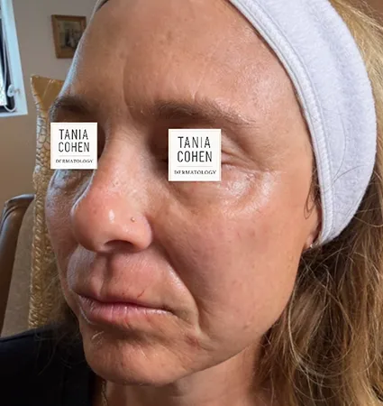 transformations_botox-fillers-pat-2-09