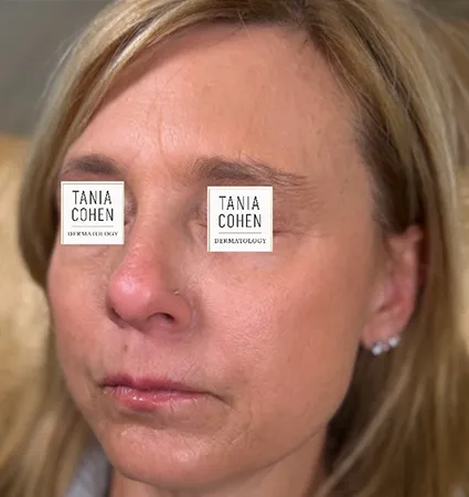 transformations_botox-fillers-pat-2-10