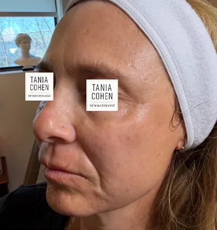 transformations_botox-fillers-pat-2-11