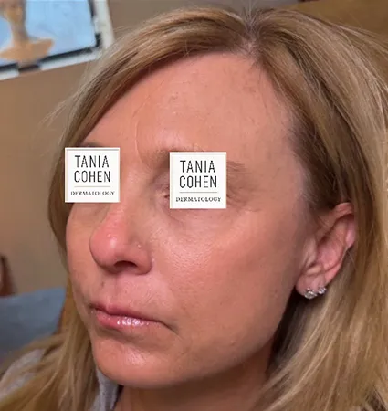 transformations_botox-fillers-pat-2-12