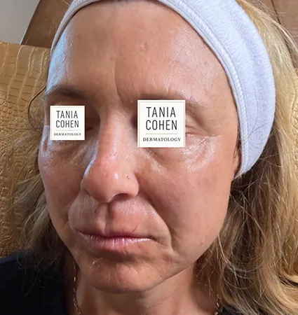 transformations_botox-fillers-pat-2-13