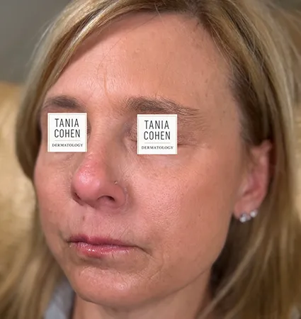transformations_botox-fillers-pat-2-14