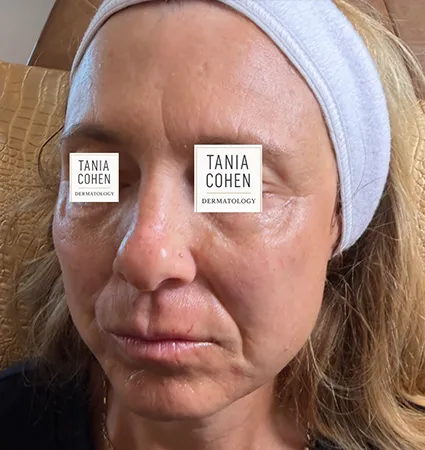 transformations_botox-fillers-pat-2-15