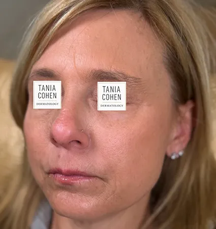 transformations_botox-fillers-pat-2-16