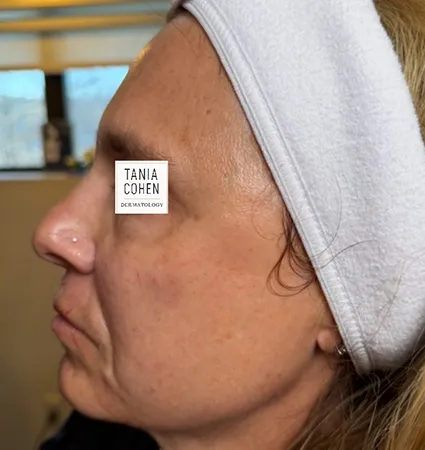 transformations_botox-fillers-pat-2-17