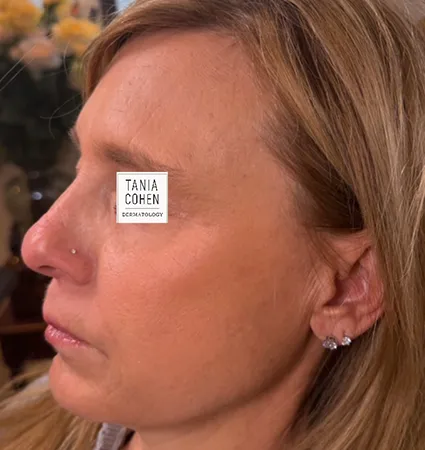transformations_botox-fillers-pat-2-18