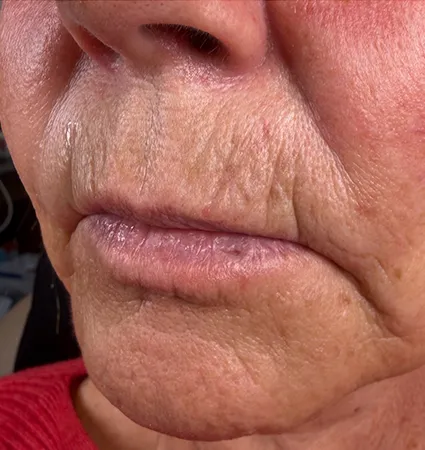 trl-contouring-above-lip-01