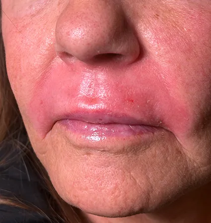 trl-contouring-above-lip-02