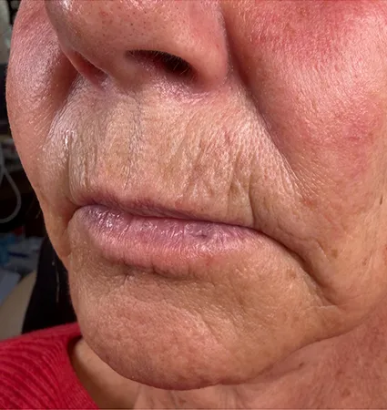 trl-contouring-above-lip-03