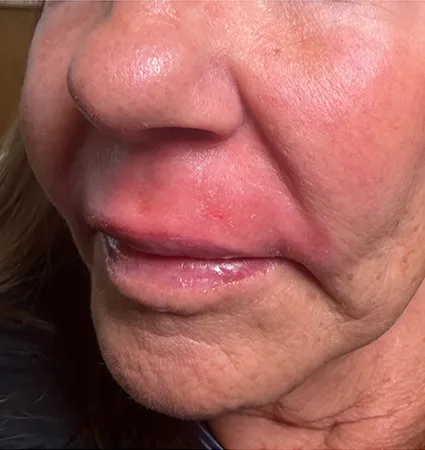 trl-contouring-above-lip-04