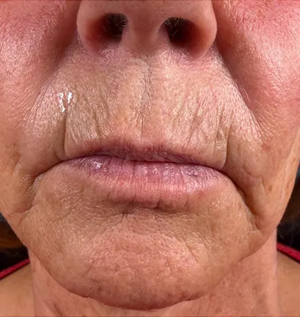 trl-contouring-above-lip-05