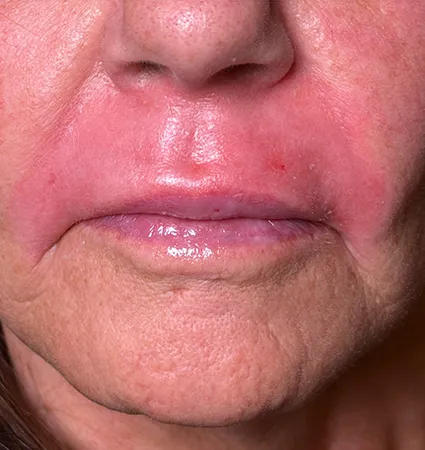 trl-contouring-above-lip-06