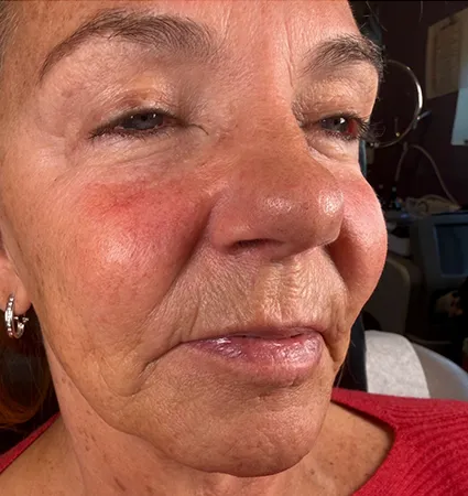trl-contouring-above-lip-07