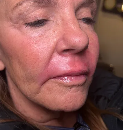 trl-contouring-above-lip-08