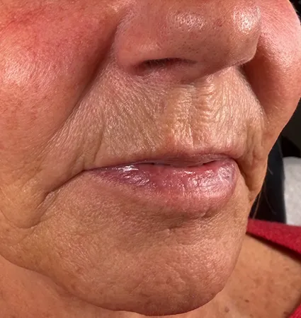trl-contouring-above-lip-09
